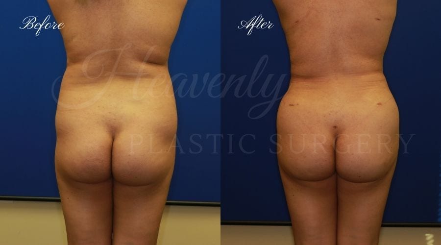 BBL Orange county, brazilian butt lift orange county, brazilian butt lift before and after, brazilian butt lift surgeon, brazilian butt lift results, bbl surgeon, bbl results, bbl before and after, fat transfer to the butt, butt augmentation, butt augmentation surgery, butt augmentation surgeon BBL Orange county, brazilian butt lift orange county, brazilian butt lift before and after, brazilian butt lift surgeon, brazilian butt lift results, bbl surgeon, bbl results, bbl before and after, fat transfer to the butt, butt augmentation, butt augmentation surgery, butt augmentation surgeon