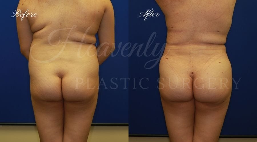 BBL Orange county, brazilian butt lift orange county, brazilian butt lift before and after, brazilian butt lift surgeon, brazilian butt lift results, bbl surgeon, bbl results, bbl before and after, fat transfer to the butt, butt augmentation, butt augmentation surgery, butt augmentation surgeon BBL Orange county, brazilian butt lift orange county, brazilian butt lift before and after, brazilian butt lift surgeon, brazilian butt lift results, bbl surgeon, bbl results, bbl before and after, fat transfer to the butt, butt augmentation, butt augmentation surgery, butt augmentation surgeon