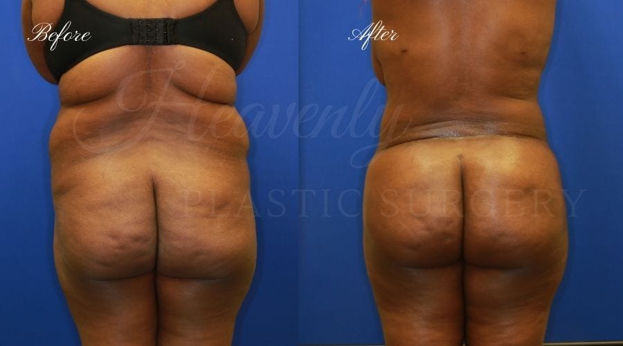 Plastic Surgery, plastic surgeon, lilpectomy, butt, bubble butt, fat grafting, peach butt, booty Plastic Surgery, plastic surgeon, lilpectomy, butt, bubble butt, fat grafting, peach butt, booty
