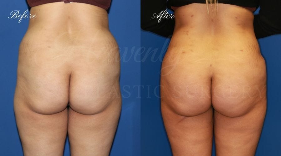 Plastic Surgery, plastic surgeon, lilpectomy, butt, bubble butt, fat grafting Plastic Surgery, plastic surgeon, lilpectomy, butt, bubble butt, fat grafting