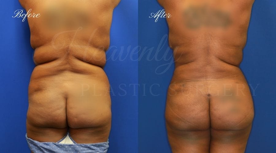 BBL Orange county, brazilian butt lift orange county, brazilian butt lift before and after, brazilian butt lift surgeon, brazilian butt lift results, bbl surgeon, bbl results, bbl before and after, fat transfer to the butt, butt augmentation, butt augmentation surgery, butt augmentation surgeon BBL Orange county, brazilian butt lift orange county, brazilian butt lift before and after, brazilian butt lift surgeon, brazilian butt lift results, bbl surgeon, bbl results, bbl before and after, fat transfer to the butt, butt augmentation, butt augmentation surgery, butt augmentation surgeon