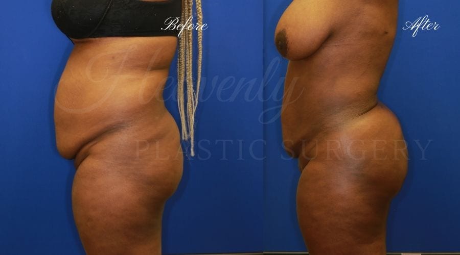 Plastic Surgery, plastic surgeon, lilpectomy, butt, bubble butt, fat grafting, peach butt, booty Plastic Surgery, plastic surgeon, lilpectomy, butt, bubble butt, fat grafting, peach butt, booty
