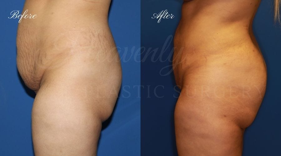 Plastic Surgery, plastic surgeon, lilpectomy, butt, bubble butt, fat grafting Plastic Surgery, plastic surgeon, lilpectomy, butt, bubble butt, fat grafting