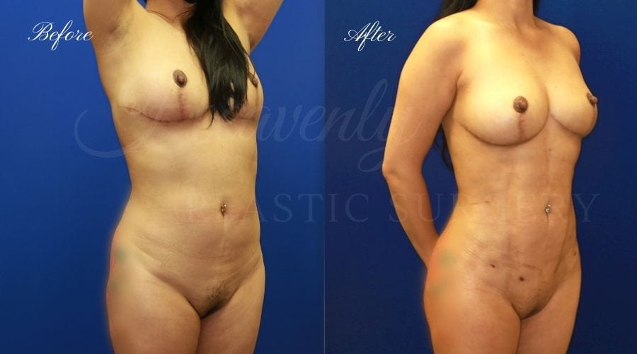 BBL Orange county, brazilian butt lift orange county, brazilian butt lift before and after, brazilian butt lift surgeon, brazilian butt lift results, bbl surgeon, bbl results, bbl before and after, fat transfer to the butt, butt augmentation, butt augmentation surgery, butt augmentation surgeon