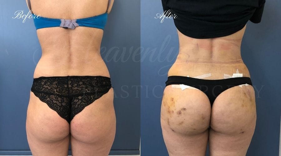 Plastic Surgery, plastic surgeon, lilpectomy, butt, bubble butt, fat grafting, peach butt, booty Plastic Surgery, plastic surgeon, lilpectomy, butt, bubble butt, fat grafting, peach butt, booty