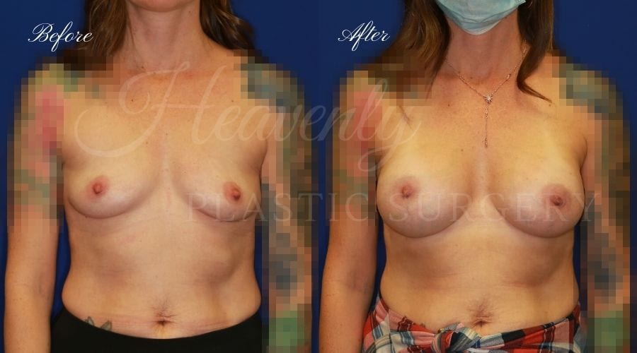 Breast Augmentation Before and After 325cc, plastic surgeon, plastic surgery, breast augmentation, enhanced breasts, boob job, implants, silicone implants