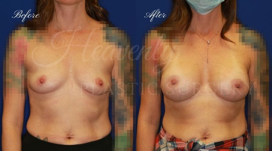 Breast Augmentation Before and After 325cc, plastic surgeon, plastic surgery, breast augmentation, enhanced breasts, boob job, implants, silicone implants Breast Augmentation Before and After 325cc, plastic surgeon, plastic surgery, breast augmentation, enhanced breasts, boob job, implants, silicone implants