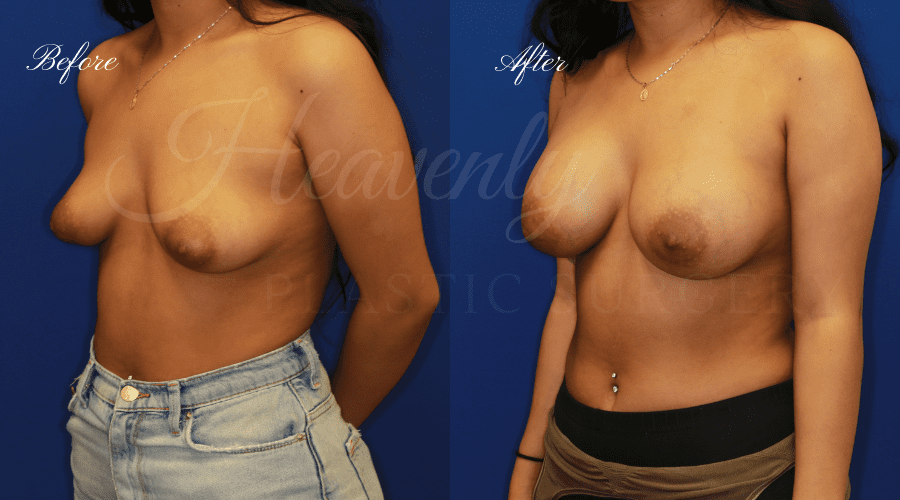 Breast Augmentation 375cc Before and After - Left Oblique, plastic surgeon, plastic surgery, breast augmentation, enhanced breasts, boob job, implants, silicone implants