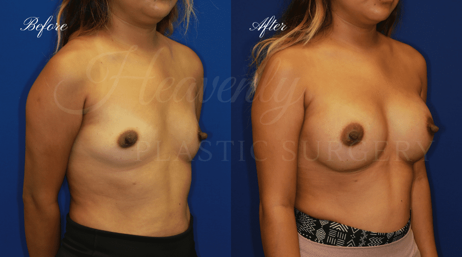 Breast Augmentation 385cc Before and After, Plastic Surgery, Plastic surgeon, breast augmentation, breast implants, augmentation mammaplasty