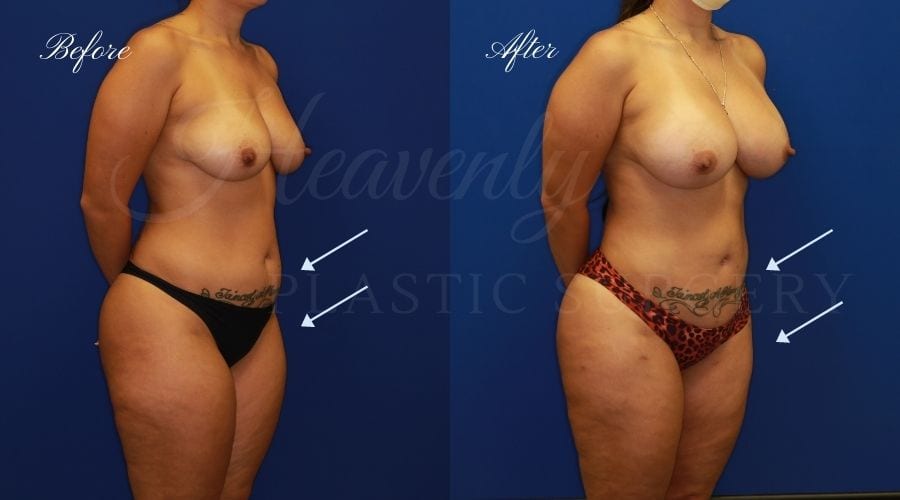 Breast Augmentation 385cc Before and After - Right Oblique, Plastic surgeon, plastic surgery, breast augmentation, breast implants, liposuction, thighs, abdomen, flanks