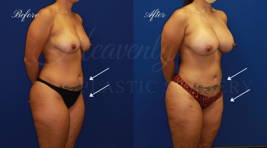 Breast Augmentation 385cc Before and After - Right Oblique, Plastic surgeon, plastic surgery, breast augmentation, breast implants, liposuction, thighs, abdomen, flanks Breast Augmentation 385cc Before and After - Right Oblique, Plastic surgeon, plastic surgery, breast augmentation, breast implants, liposuction, thighs, abdomen, flanks