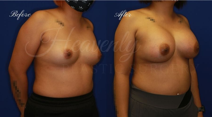 Breast Augmentation 420cc Before and After, plastic surgeon, plastic surgery, breast augmentation, enhanced breasts, boob job, implants, silicone implants