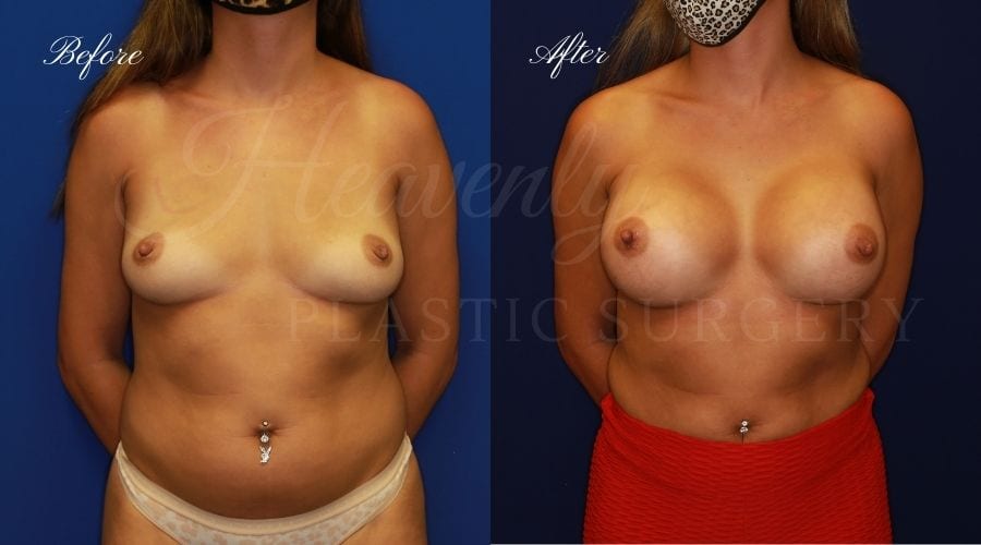 Breast Augmentation 445cc Before and After, plastic surgeon, plastic surgery, breast augmentation, enhanced breasts, boob job, implants, silicone implants