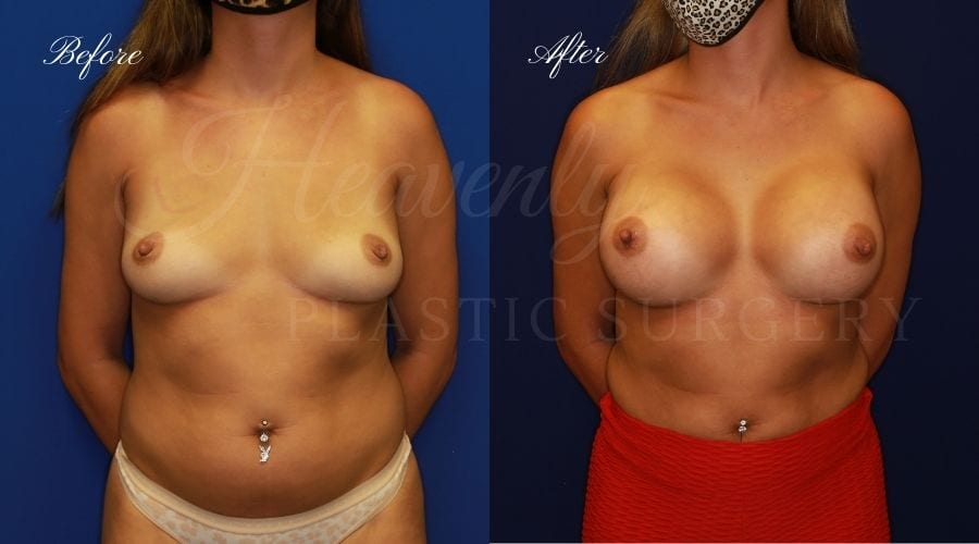 Breast Augmentation 445cc Before and After, plastic surgeon, plastic surgery, breast augmentation, enhanced breasts, boob job, implants, silicone implants Breast Augmentation 445cc Before and After, plastic surgeon, plastic surgery, breast augmentation, enhanced breasts, boob job, implants, silicone implants