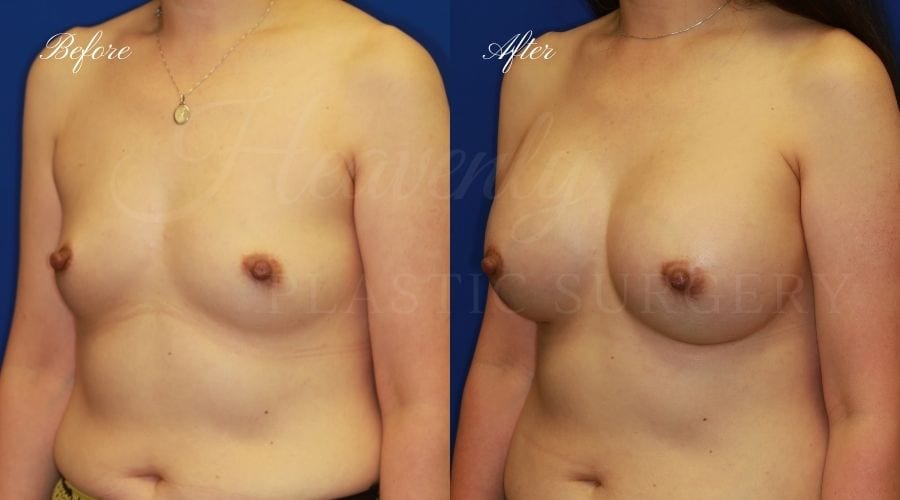 Plastic Surgery, Plastic surgeon, breast augmentation, breast implants, augmentation mammaplasty, 470cc implant, natrelle