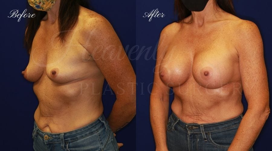 Breast Augmentation 505cc Before and After
