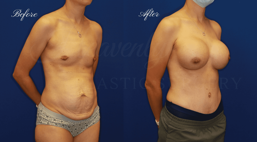Breast Augmentation 545cc Before and After - Right Oblique JAAN