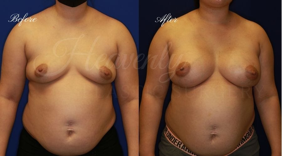 Breast Augmentation 605cc Before and After, plastic surgeon, plastic surgery, breast augmentation, enhanced breasts, boob job, implants, silicone implants