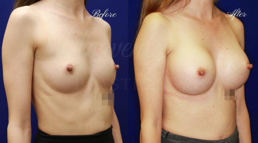 Plastic Surgery, Plastic surgeon, breast augmentation, breast implants, augmentation mammaplasty