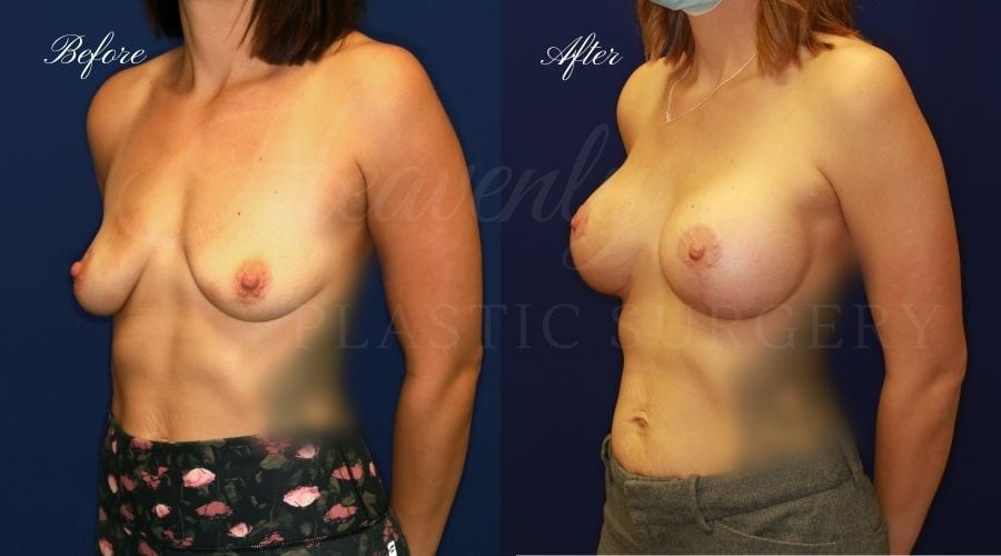 Breast Lift with Implants (Mastopexy-Augmentation) Before and After, Heavenly Plastic Surgery, Plastic Surgery, Plastic Surgeon, Breast Surgery, Breast Lift, Breast Lift with Implants, Breast Implants