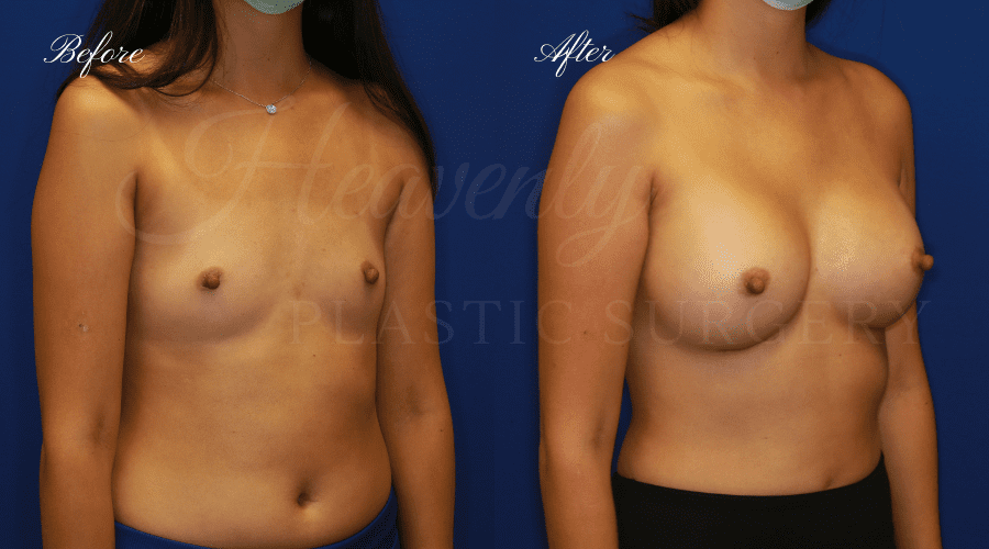 Plastic surgery, plastic surgeon, breast augmentation, breast implants, augmentation mammaplasty, before and after breast augmentation, bigger breasts, bigger boobs, boob job