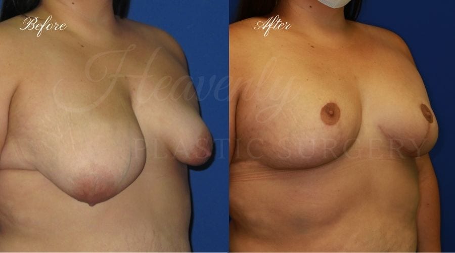 Plastic surgery, plastic surgeon, before and after breast lift, breast lift, mastopexy
