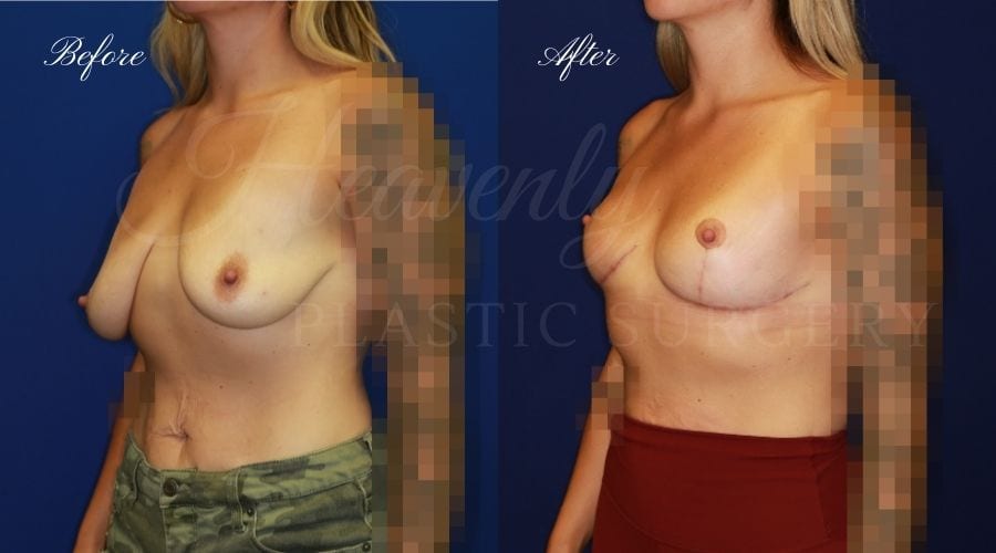 Plastic Surgery, Plastic Surgeon, Breast Lift, Mastopexy, Donut Scar, Breast Lift Before and After, Mastopexy Before and After