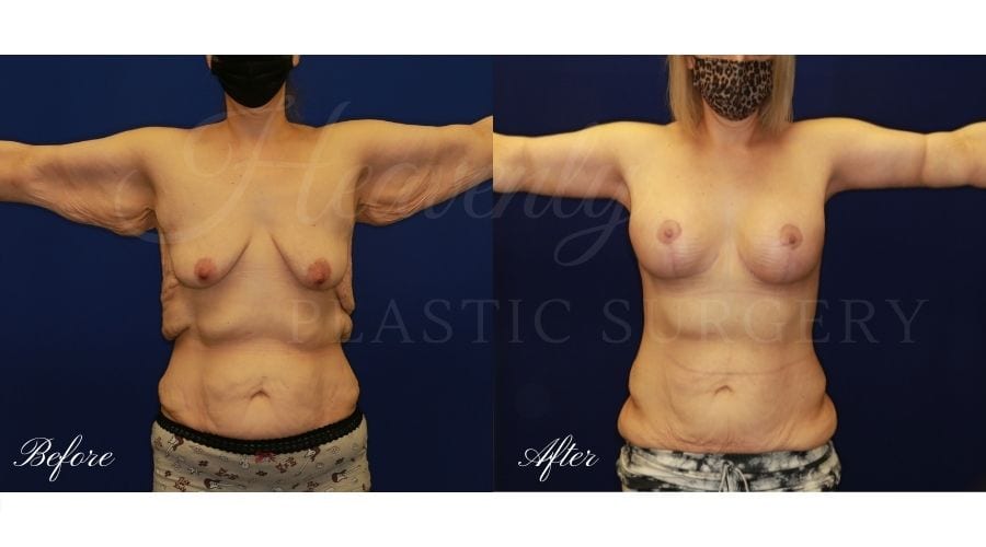 Breast Lift with Implants (Mastopexy-Augmentation) + Back Lift Before and After, Back Lift, Back Lift Surgery, Reverse Tummy Tuck, Weight-loss Surgery, Weight Loss Surgery, Arm Lift, Brachioplasty, Breast Lift, Mastopexy, Reverse Tummy Tuck Surgery, Upper Body Lift, Upper Body Surgery, Upper Body Lift Surgery, Upper Body Lift Orange County, Back Lift Orange County, Arm LIft Orange County, Arm Lift Surgeon, Weight-loss Surgeon, Weight Loss Surgeon, Weight Loss Surgery Orange County, Weight Loss Surgery Before and After, Weight-Loss Surgery Before and After, Transformation
