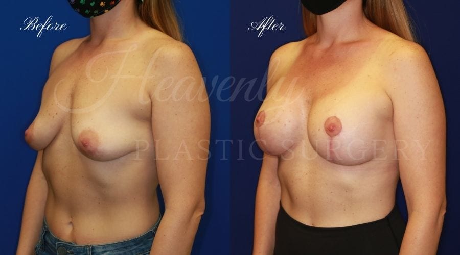 Breast Lift with Implants (Mastopexy-Augmentation) Before and After, Heavenly Plastic Surgery, Plastic Surgery, Plastic Surgeon, Breast Surgery, Breast Lift, Breast Lift with Implants, Breast Implants
