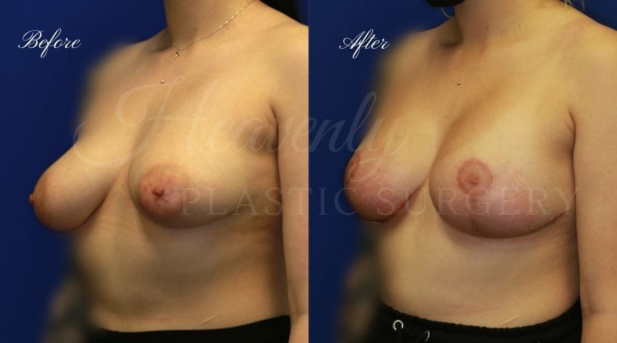 Breast Lift with Implants (Mastopexy-Augmentation) Before and After, Plastic Surgery, Plastic Surgeon, Breast Lift, Mastopexy, Mastopexy Augmentation, Mastopexy-augmentation, breast lift with implants