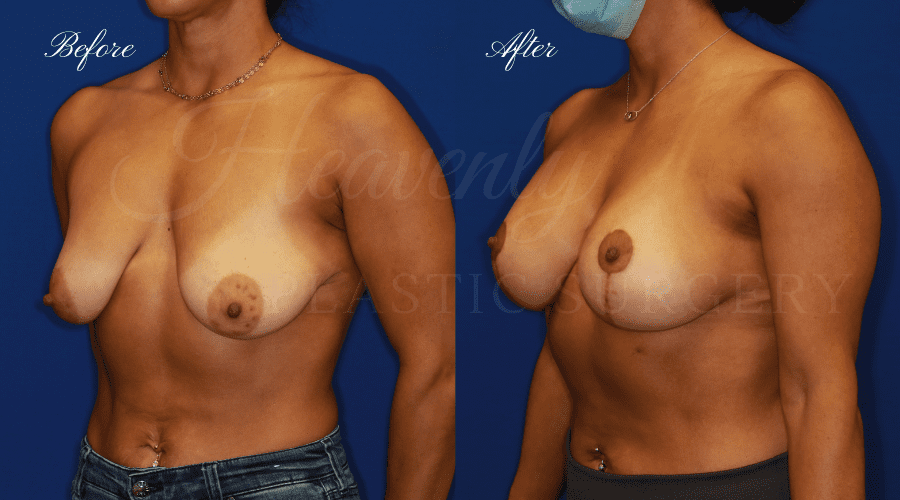 Mastopexy Augmentation (Breast Implants with Lift) - 310cc SRM Silicone breast implants with Wise-pattern breast lift (Anchor scar), plastic surgery