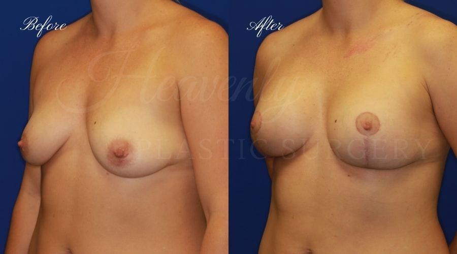 Breast Lift with Implants (Mastopexy-Augmentation) Before and After, Breast lift with implants orange county, plastic surgery before and after, plastic surgery orange county, breast surgery orange county, boob job orange county, boob job california