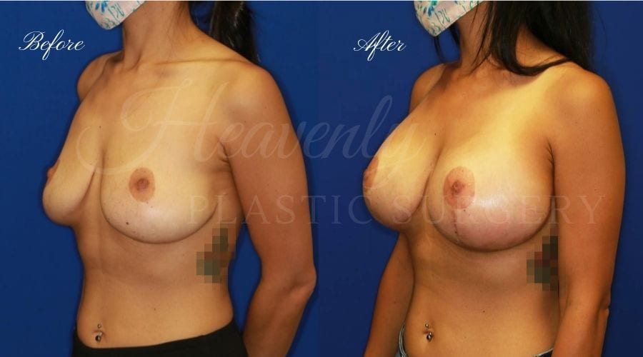 Mastopexy Augmentation (Breast Implants with Lift) - 310cc SRM Silicone breast implants with Wise-pattern breast lift (Anchor scar), plastic surgery