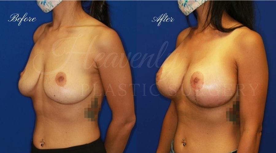 Mastopexy Augmentation (Breast Implants with Lift) - 310cc SRM Silicone breast implants with Wise-pattern breast lift (Anchor scar), plastic surgery Mastopexy Augmentation (Breast Implants with Lift) - 310cc SRM Silicone breast implants with Wise-pattern breast lift (Anchor scar), plastic surgery