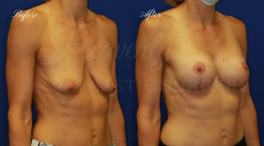 Breast Lift with Implants Before and After, Mastopexy Augmentation (Breast Implants with Lift) - 310cc SRM Silicone breast implants with Wise-pattern breast lift (Anchor scar), plastic surgery