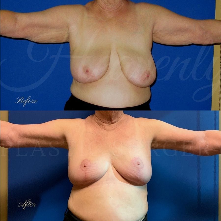 Breast Reduction + Arm Lift Before and After, Plastic surgery, plastic surgeon, arm lift, breast lift, breast reduction, brachioplasty