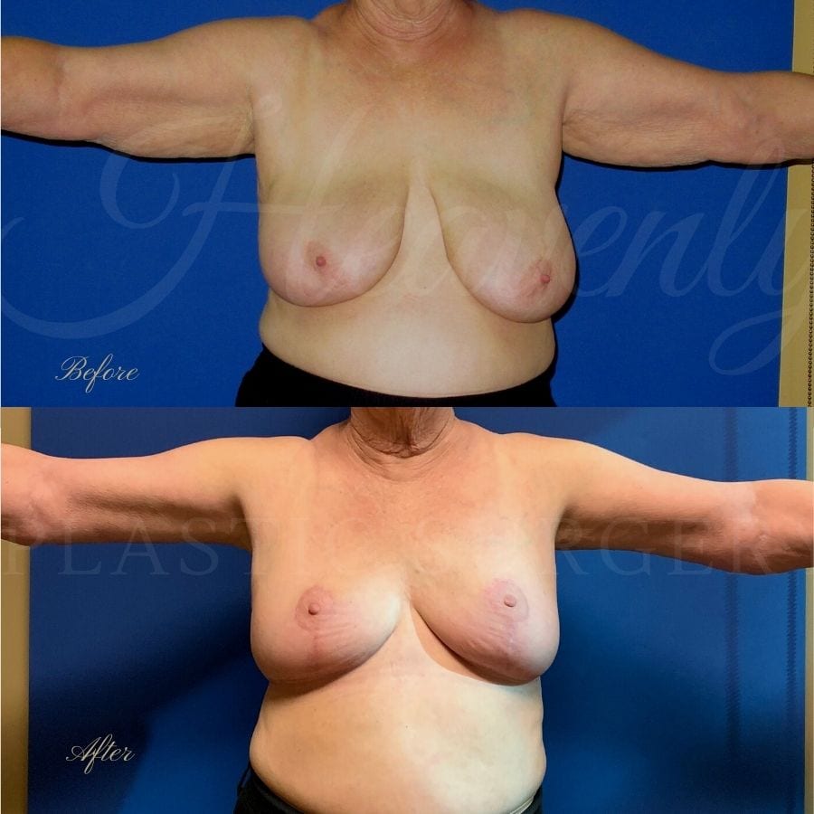 Breast Reduction + Arm Lift Before and After, Plastic surgery, plastic surgeon, arm lift, breast lift, breast reduction, brachioplasty Breast Reduction + Arm Lift Before and After, Plastic surgery, plastic surgeon, arm lift, breast lift, breast reduction, brachioplasty