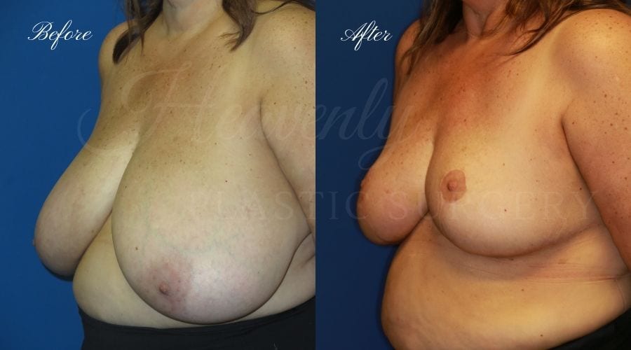 Plastic surgery, plastic surgeon, breast reduction, breast lift, reduction mammaplasty, mastopexy, before and after