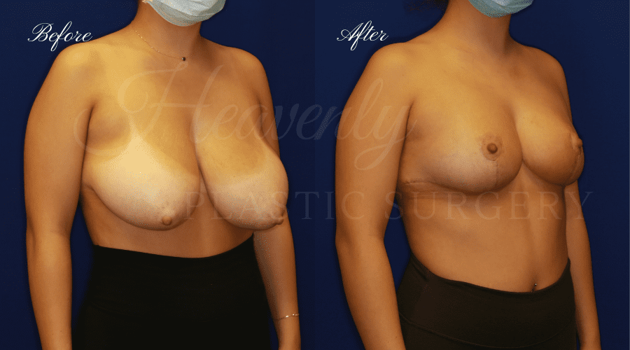 Breast Reduction Before and After, Plastic surgery, plastic surgeon, breast reduction, breast lift, reduction mammaplasty, mastopexy, before and after, mastopexy Breast Reduction Before and After, Plastic surgery, plastic surgeon, breast reduction, breast lift, reduction mammaplasty, mastopexy, before and after, mastopexy
