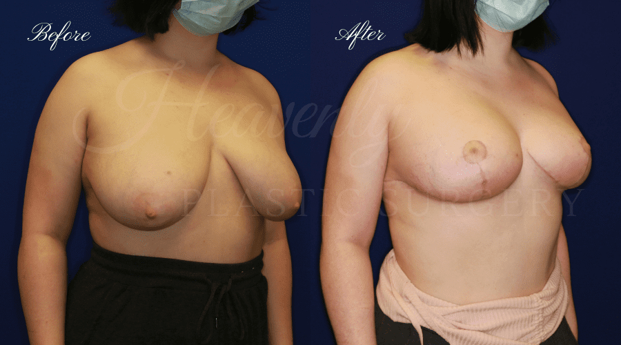 Breast Reduction Before and After, Plastic surgery, plastic surgeon, breast reduction, breast lift, reduction mammaplasty, mastopexy, before and after, mastopexy
