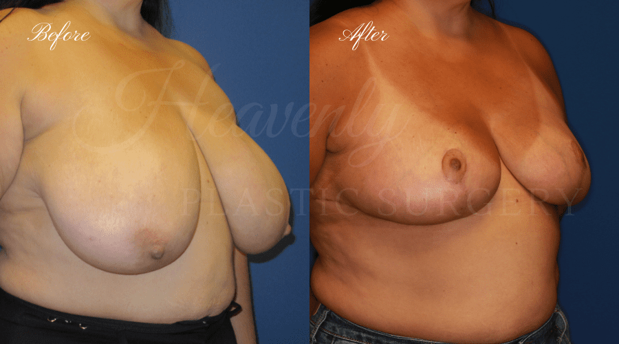 Breast Reduction Before and After, Plastic surgery, plastic surgeon, breast reduction, breast lift, reduction mammaplasty, mastopexy, before and after, mastopexy