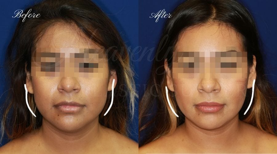 Buccal Fat Pad Removal, Buccal Fat Pad Removal Surgery, Cheekbone surgery, Cheek Plastic Surgery, Cheekbone Plastic Surgery, Cheek Surgery, Cheek Plastic Surgery, Contour Buccal Fat Pad Removal, Buccal Fat Pad Removal Surgery, Cheekbone surgery, Cheek Plastic Surgery, Cheekbone Plastic Surgery, Cheek Surgery, Cheek Plastic Surgery, Contour