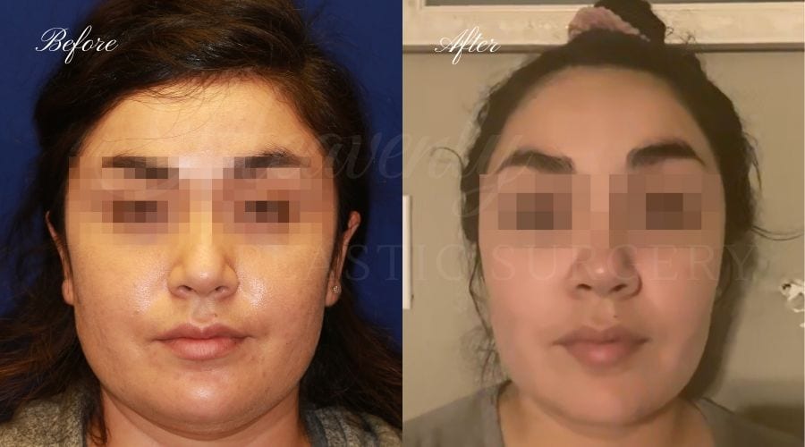 Buccal Fat Pad Removal, Buccal Fat Pad Removal Surgery, Cheekbone surgery, Cheek Plastic Surgery, Cheekbone Plastic Surgery, Cheek Surgery, Cheek Plastic Surgery, Contour Buccal Fat Pad Removal, Buccal Fat Pad Removal Surgery, Cheekbone surgery, Cheek Plastic Surgery, Cheekbone Plastic Surgery, Cheek Surgery, Cheek Plastic Surgery, Contour
