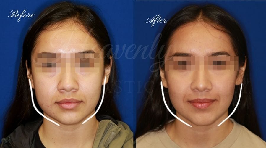 Plastic Surgeon, Plastic Surgery, Heavenly Plastic Surgery, Buccal Fat Pad Removal, Contour, Face Surgery, Millenneal Makeover, Cheek Surgery, Cheekbone Surgery, Cheekbones Plastic Surgeon, Plastic Surgery, Heavenly Plastic Surgery, Buccal Fat Pad Removal, Contour, Face Surgery, Millenneal Makeover, Cheek Surgery, Cheekbone Surgery, Cheekbones