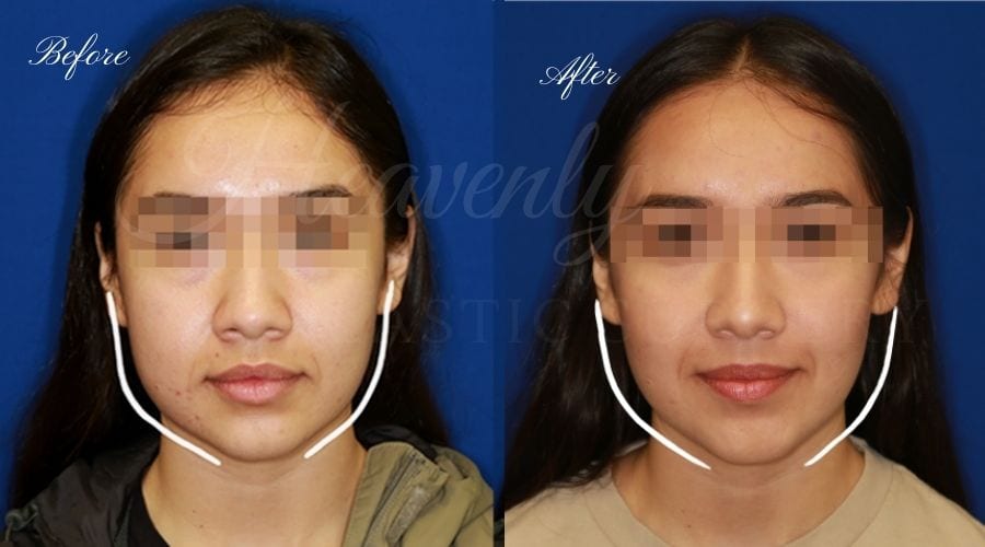 Buccal Fat Pad Removal Before and After Photo Gallery, San Diego, CA