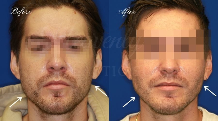 Buccal Fat Pad Removal Before and After - Front JUPH Buccal Fat Pad Removal, Buccal Fat Pad Removal Surgery, Cheekbone surgery, Cheek Plastic Surgery, Cheekbone Plastic Surgery, Cheek Surgery, Cheek Plastic Surgery, Contour, male plastic surgery, male buccal fat pad removel, male cheekbone surgery, male cheek surgery, buccal fat pad removal orange county, buccal fat pad removal surgeon