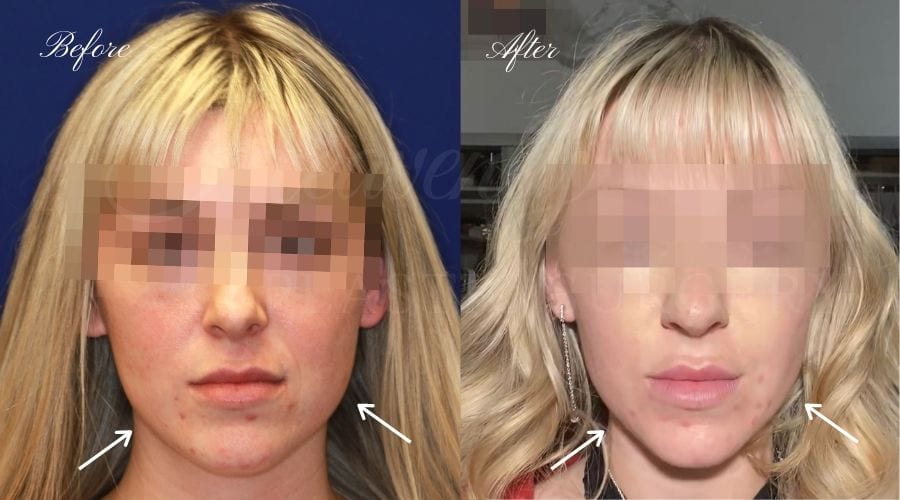 Buccal Fat Pad Removal, Buccal Fat Pad Removal Surgery, Cheekbone surgery, Cheek Plastic Surgery, Cheekbone Plastic Surgery, Cheek Surgery, Cheek Plastic Surgery, Contour Buccal Fat Pad Removal, Buccal Fat Pad Removal Surgery, Cheekbone surgery, Cheek Plastic Surgery, Cheekbone Plastic Surgery, Cheek Surgery, Cheek Plastic Surgery, Contour