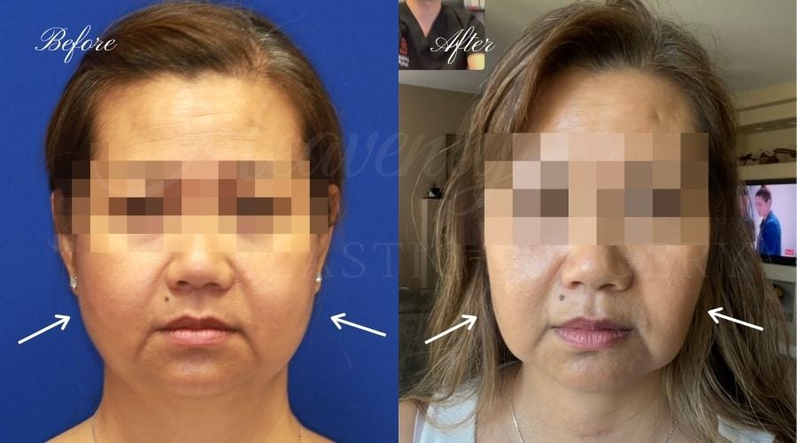 Buccal Fat Pad Removal, Buccal Fat Pad Removal Surgery, Cheekbone surgery, Cheek Plastic Surgery, Cheekbone Plastic Surgery, Cheek Surgery, Cheek Plastic Surgery, Contour Buccal Fat Pad Removal, Buccal Fat Pad Removal Surgery, Cheekbone surgery, Cheek Plastic Surgery, Cheekbone Plastic Surgery, Cheek Surgery, Cheek Plastic Surgery, Contour