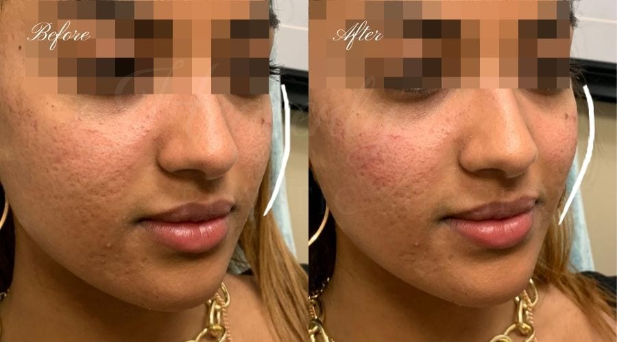 Heavenly Plastic Surgery, Pastic Surgery, Plastic Surgeon, Fillers, Cheek Fillers, Cheekbone Fillers, Cheek Bone Fillers, Volluma Heavenly Plastic Surgery, Pastic Surgery, Plastic Surgeon, Fillers, Cheek Fillers, Cheekbone Fillers, Cheek Bone Fillers, Volluma