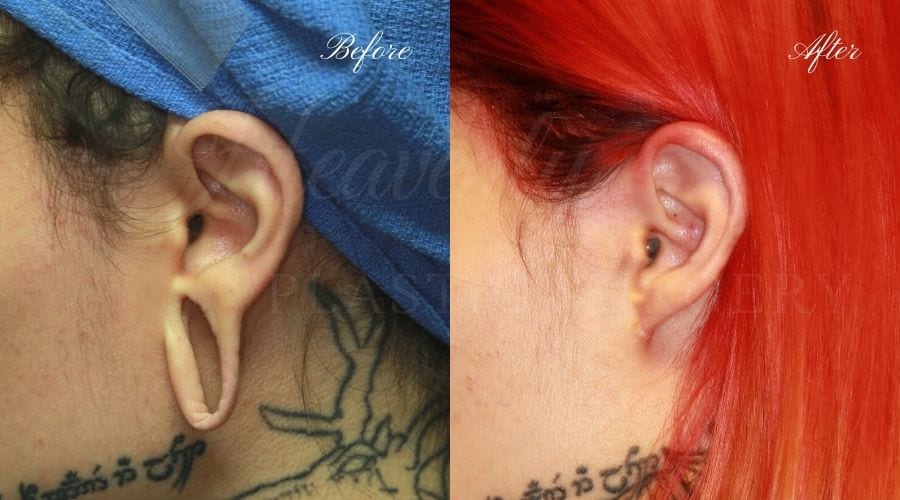 Gauge Torn Earlobe Repair San Diego CA